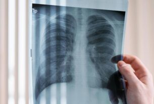 Imagem de pulmão de paciente com DPOC (Doença Pulmonar Obstrutiva Crônica), doença que teve medicamento de alto custo incorporado no rol dos planos de saúde - Pexels