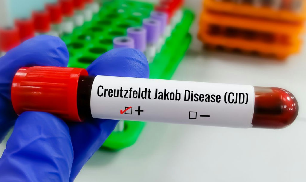 Ciência intensifica busca por terapias contra a rara doença de Creutzfeldt-jakob