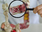 Doenças inflamatórias intestinais disparam cinco vezes no Brasil e acendem alerta de saúde pública