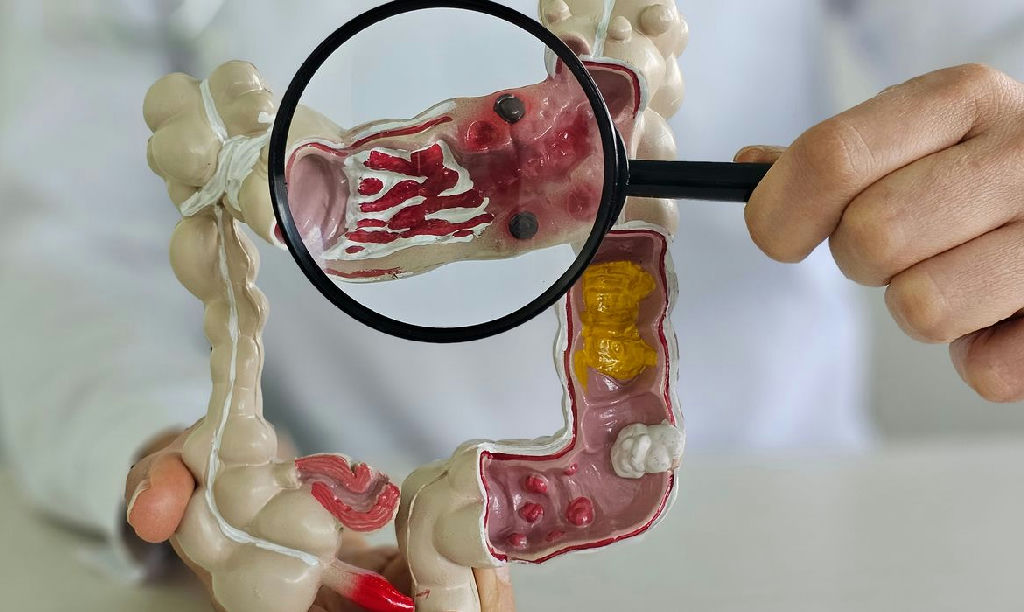 Doenças inflamatórias intestinais disparam cinco vezes no Brasil e acendem alerta de saúde pública