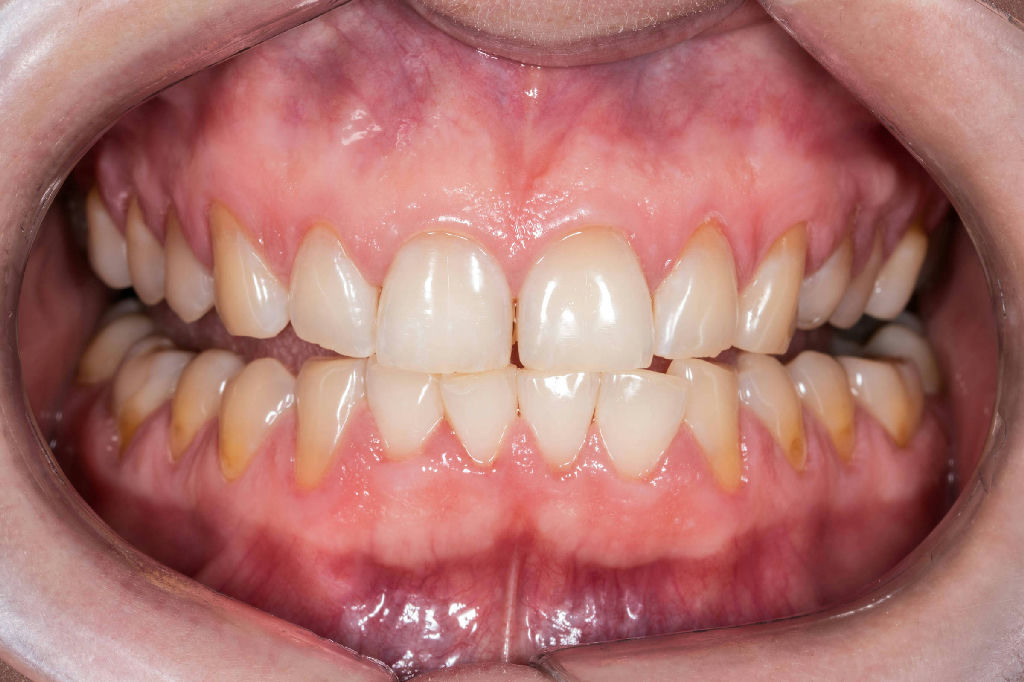 Estudo aponta ômega-3 e AAS como alternativa eficaz a antibióticos para periodontite grave