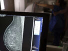 Planos de saúde passam a cobrir mamografia digital sem restrição de idade