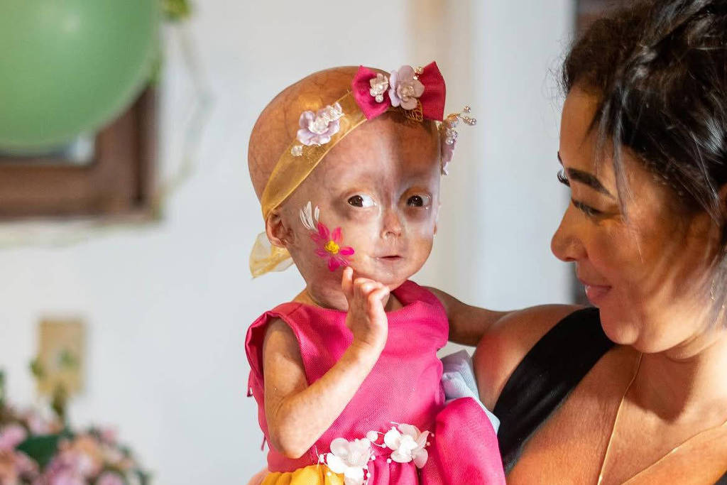 Elis Lima Carneiro morre aos 5 anos: entenda a progéria e seus impactos